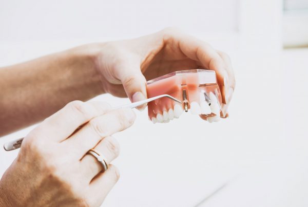 dental_implants_smileloft_westwood